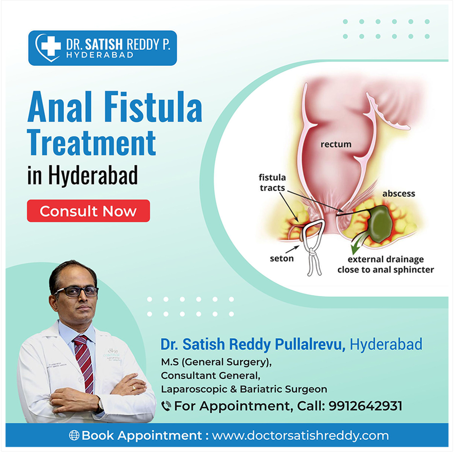 Anal Fistula Treatment