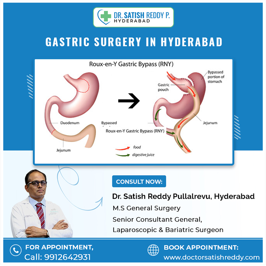 Gastric Surgery